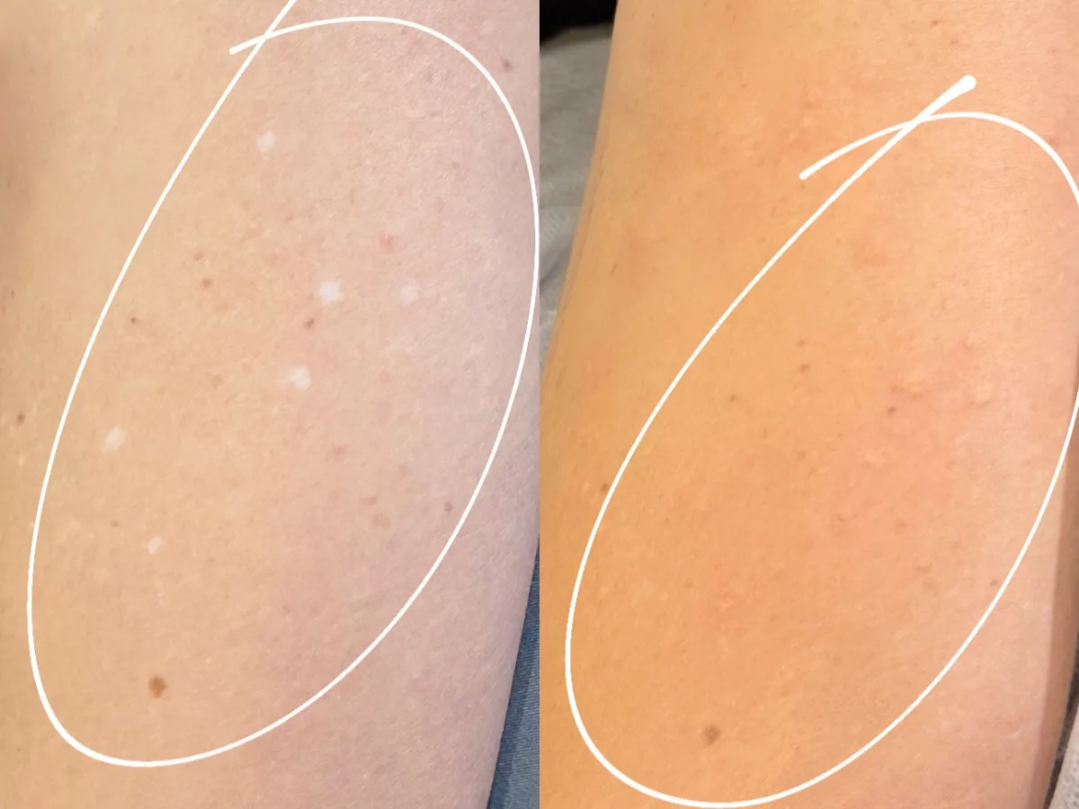 Before and after paramedical tattoo correcting hypopigmentation on arm — 1 session