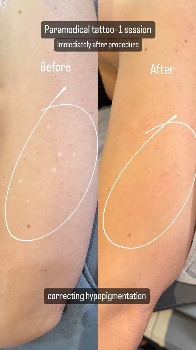 Before and after paramedical tattoo for hypopigmentation correction — 1 session