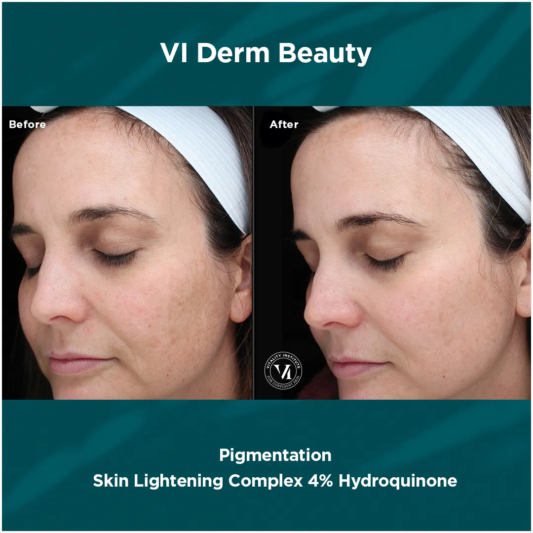 Facial sun damage before and after VI Derm Skin Lightening Complex