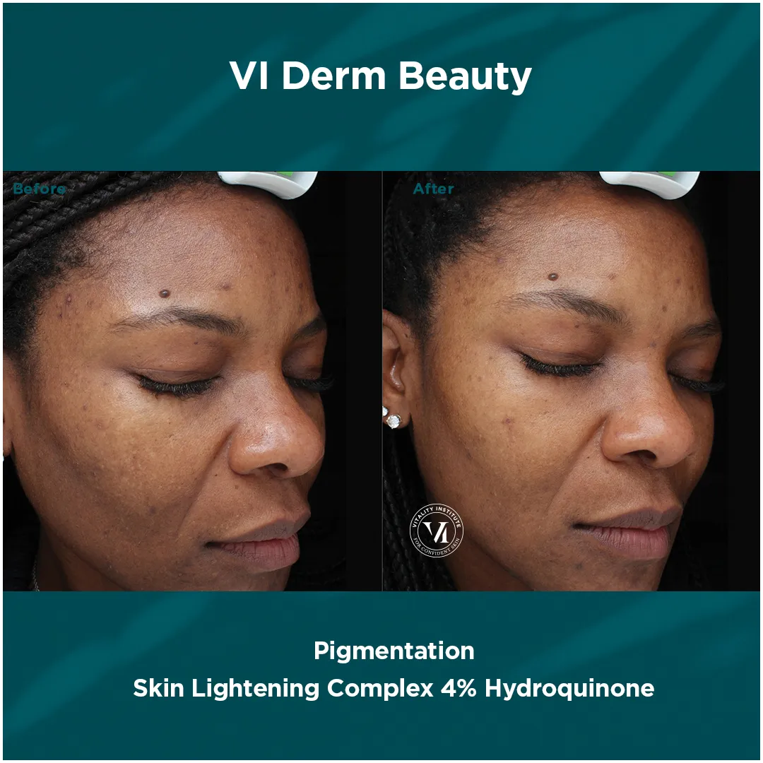 Facial pigmentation on deeper skin tone before and after VI Derm Skin Lightening Complex