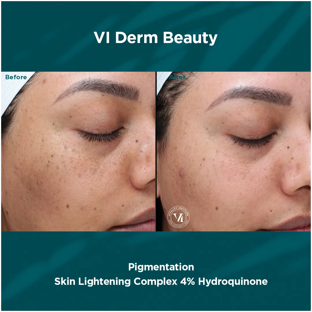 Facial pigmentation on medium skin tone before and after VI Derm Skin Lightening Complex