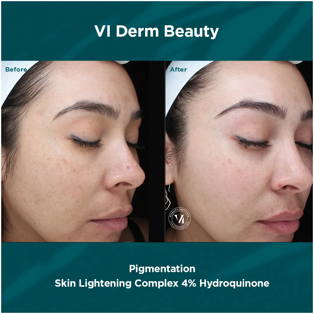 Facial pigmentation on olive skin before and after VI Derm Skin Lightening Complex