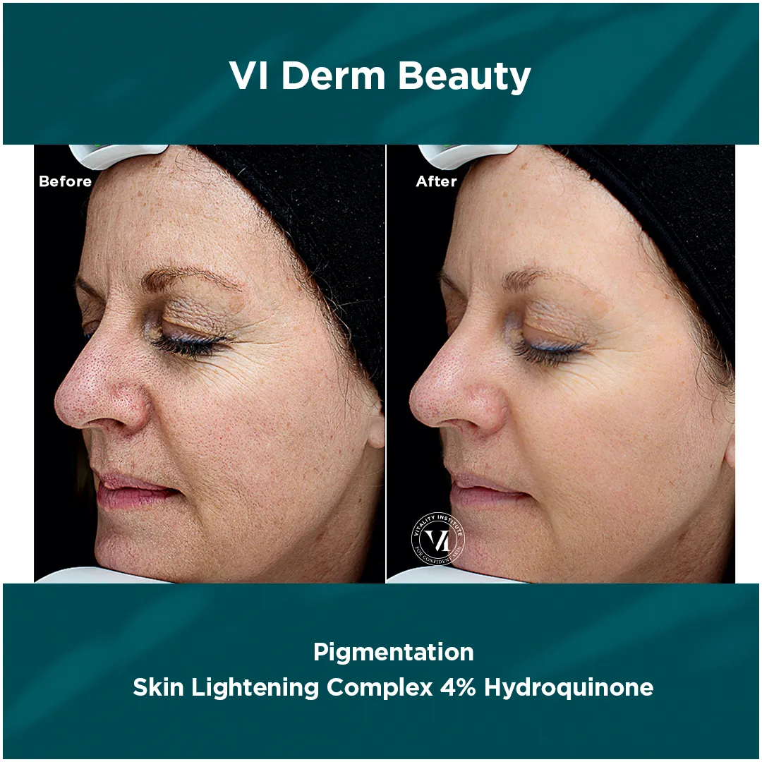 Facial pigmentation before and after VI Derm Skin Lightening Complex 4% Hydroquinone
