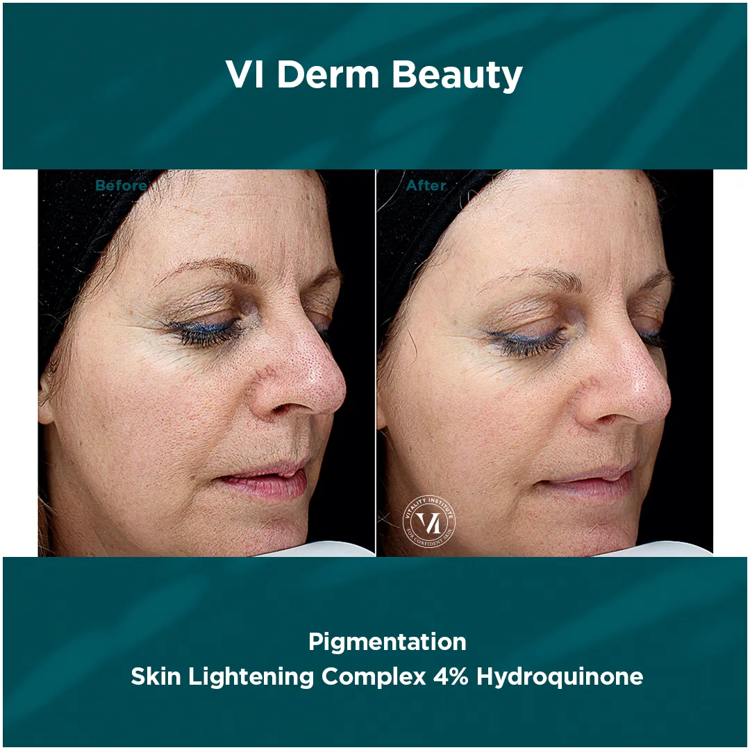 Facial redness and pigmentation on mature skin before and after VI Derm Skin Lightening Complex
