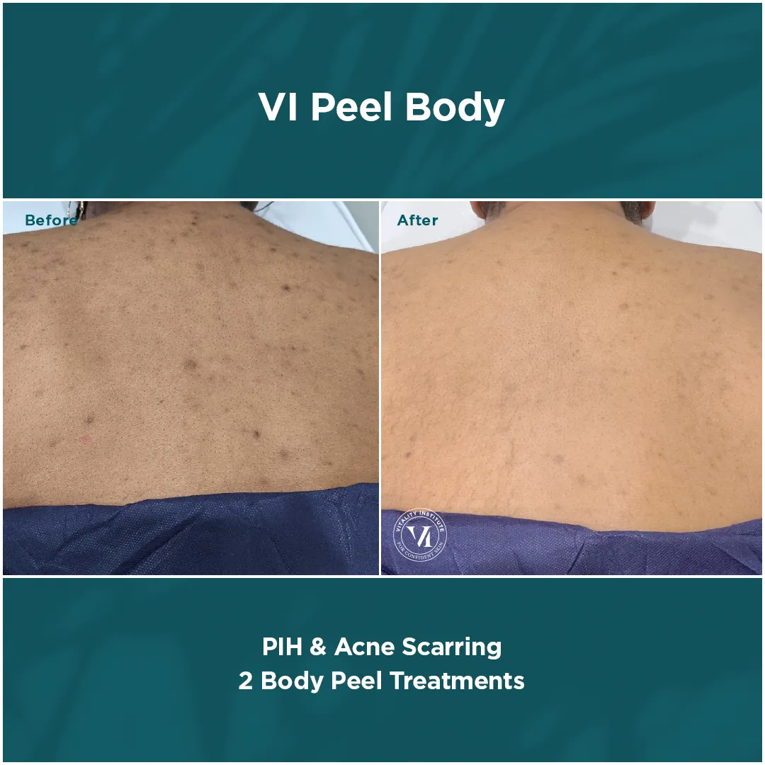 Back PIH and acne scarring before and after 2 VI Peel Body treatments