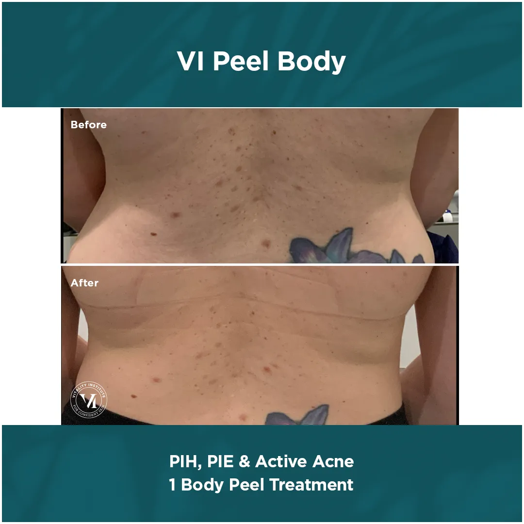 Lower torso PIH, PIE and active acne before and after 1 VI Peel Body treatment