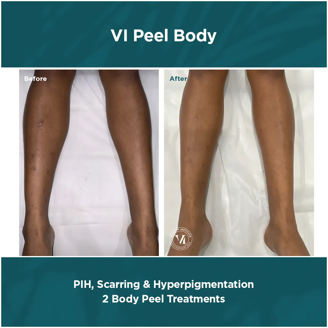 PIH, scarring and hyperpigmentation on legs before and after 2 VI Peel Body treatments
