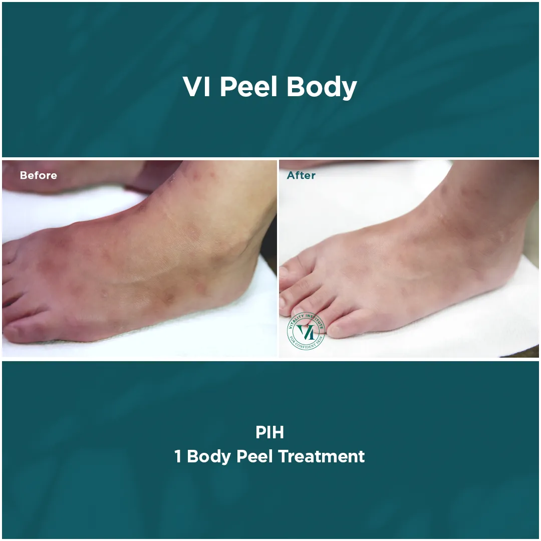 Foot and ankle PIH before and after 1 VI Peel Body treatment