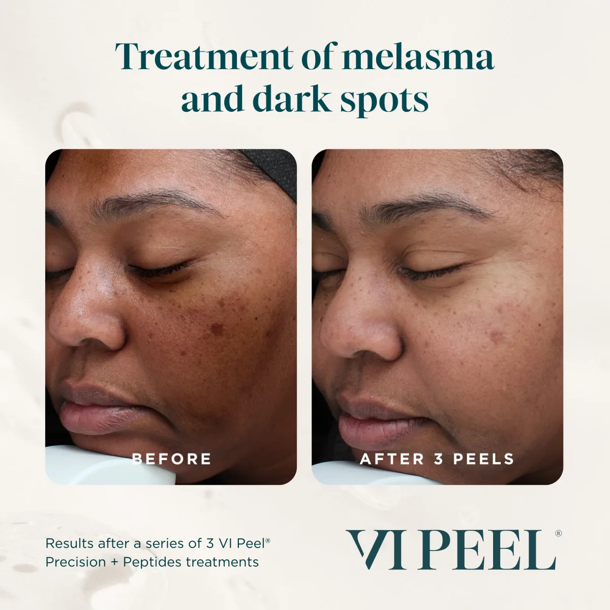 Eye area melasma progression: Before, After 1, After 2, After 3 VI Peel Precision + Peptides