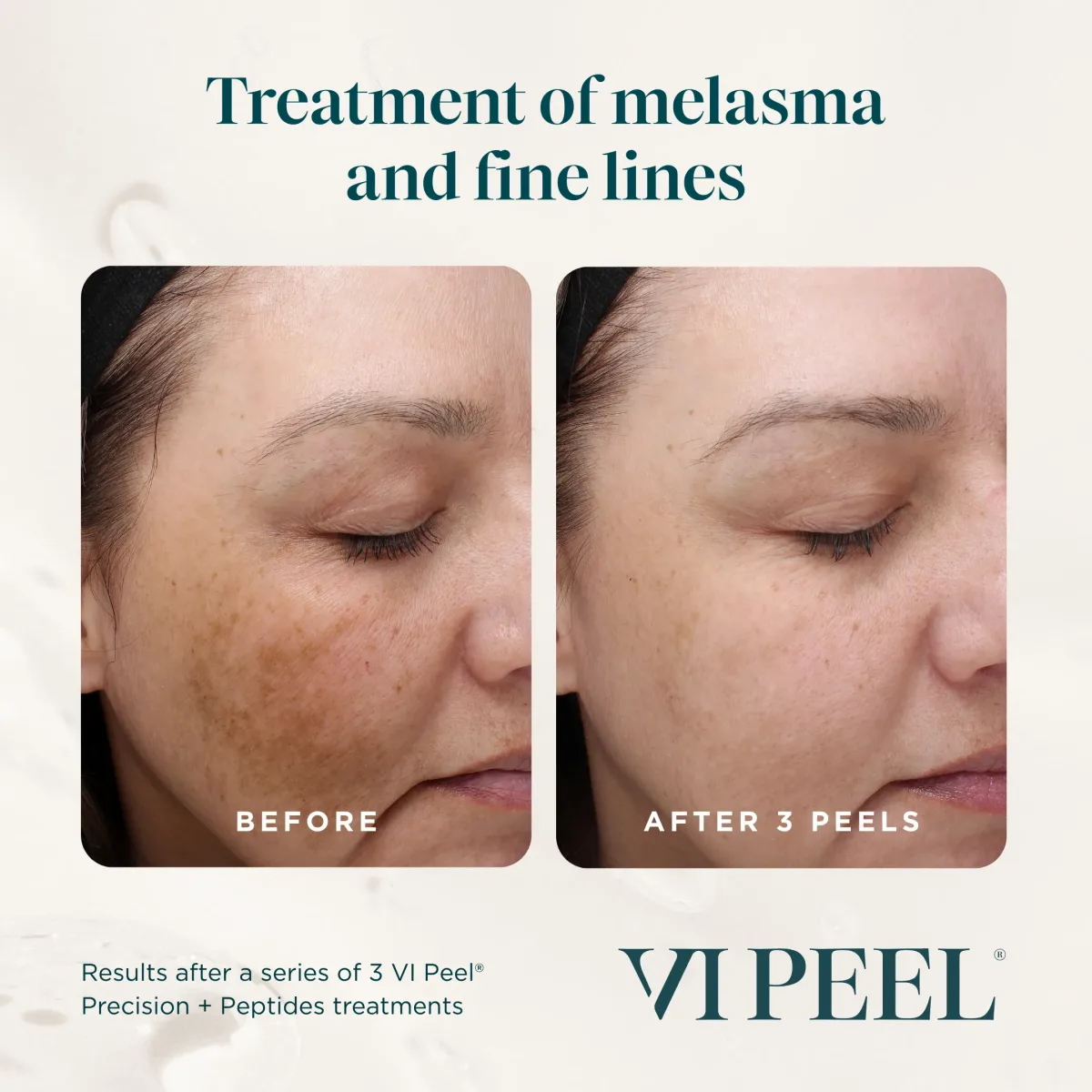 Cheek and under-eye melasma with fine lines before and after 3 VI Peel Precision + Peptides