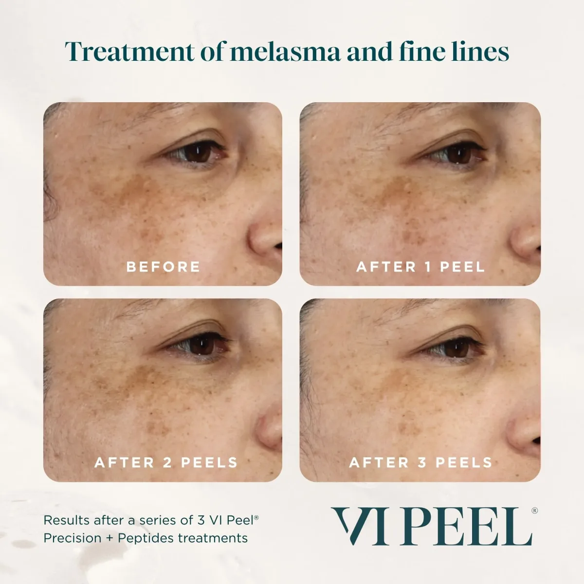 Cheek melasma and fine lines before and after 3 VI Peel Precision + Peptides