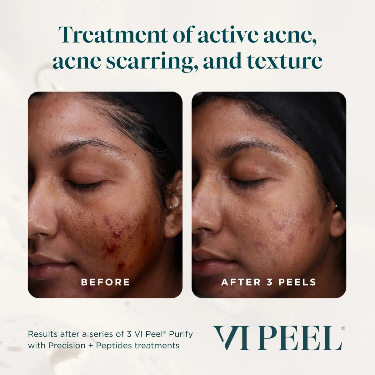 Active acne, scarring and texture before and after 3 VI Peel Purify with Precision + Peptides