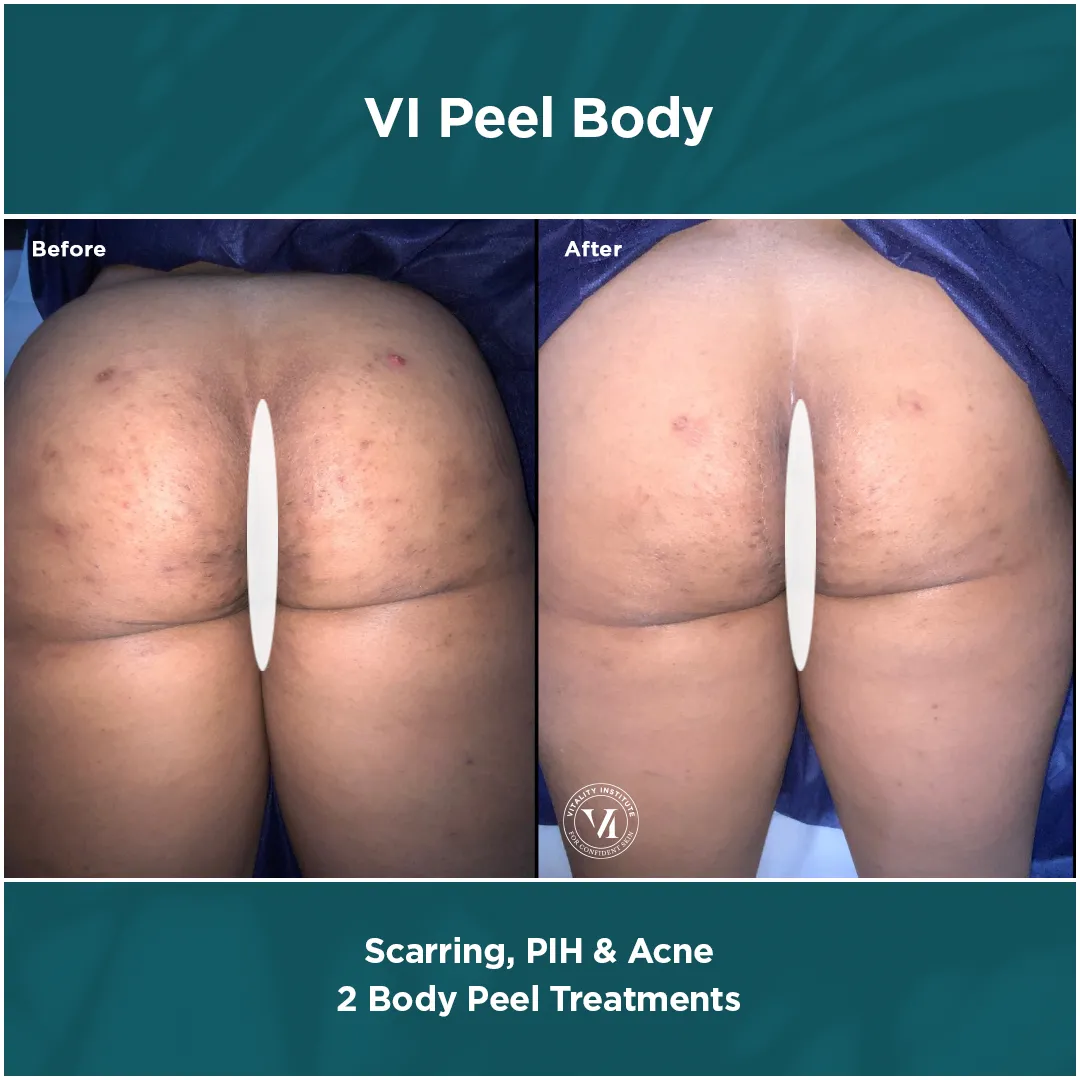 Buttocks scarring, PIH and acne before and after 2 VI Peel Body treatments