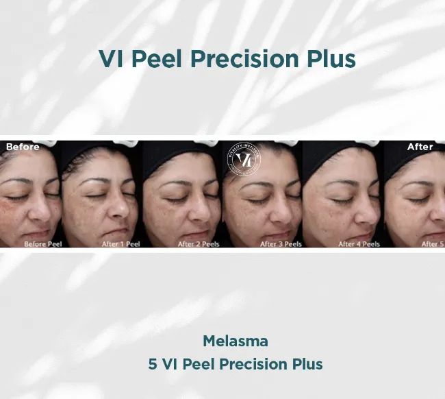Melasma progressive clearance before peel through after 5 VI Peel Precision Plus sessions
