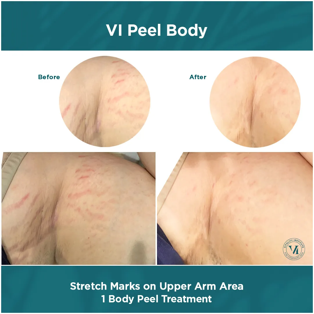 Stretch marks on upper arm area before and after 1 VI Peel Body treatment