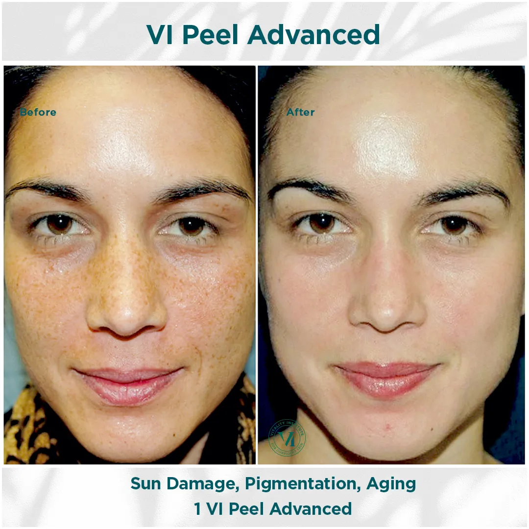 Full face sun damage, pigmentation and aging before and after 1 VI Peel Advanced