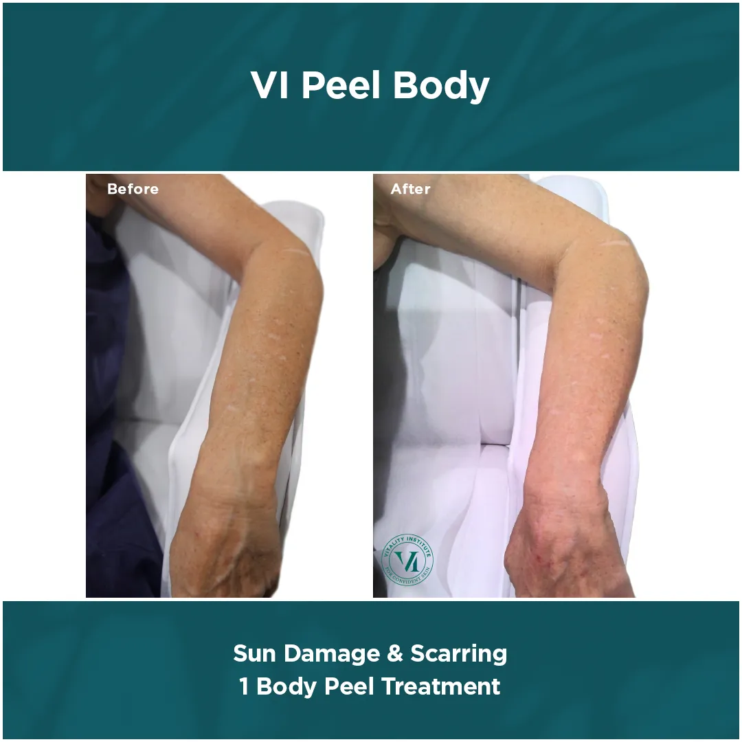 Forearm sun damage and scarring before and after 1 VI Peel Body treatment
