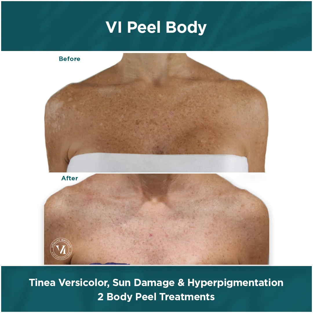 Chest tinea versicolor, sun damage and hyperpigmentation before and after 2 VI Peel Body treatments