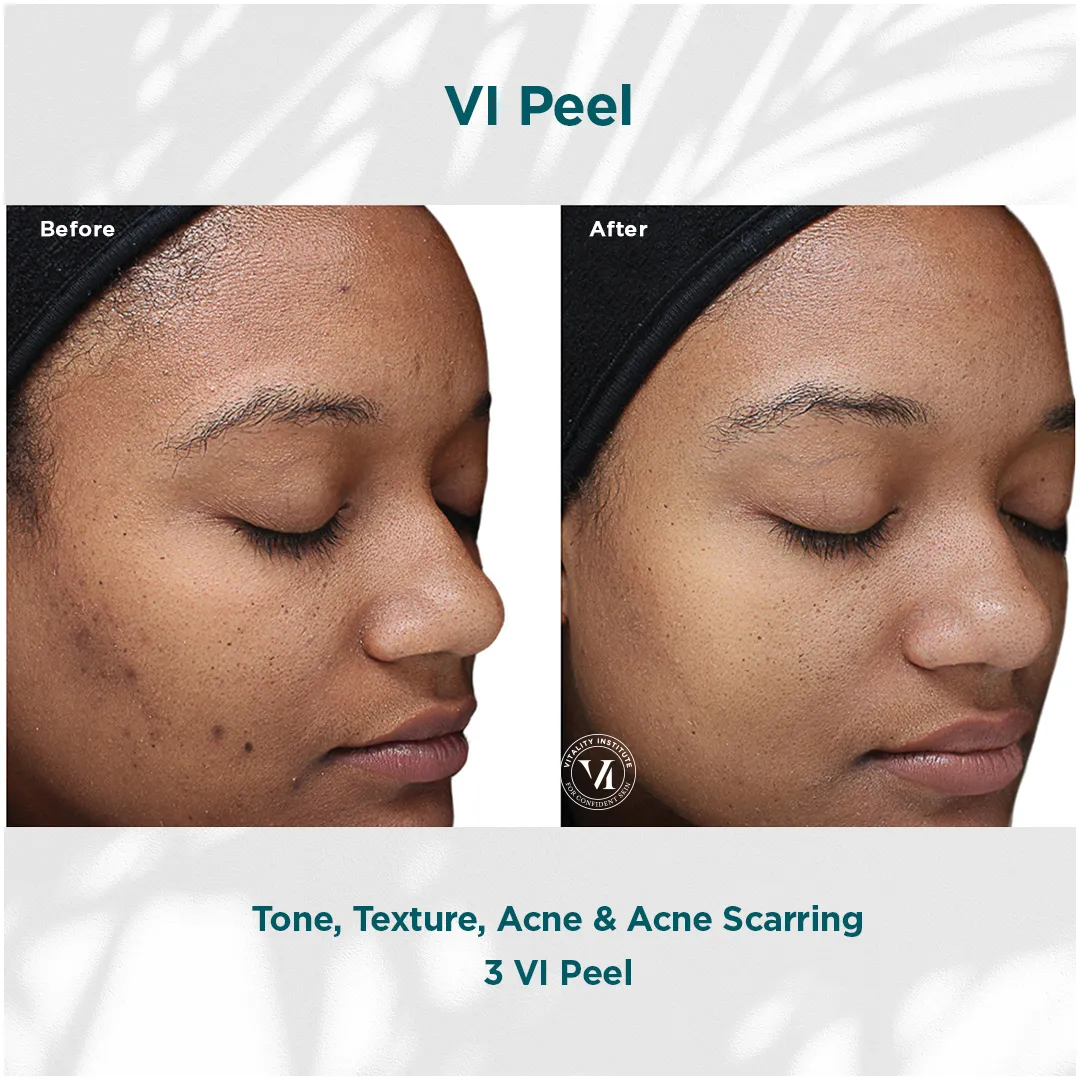 Tone, texture, acne and acne scarring on deep skin tone before and after 3 VI Peel