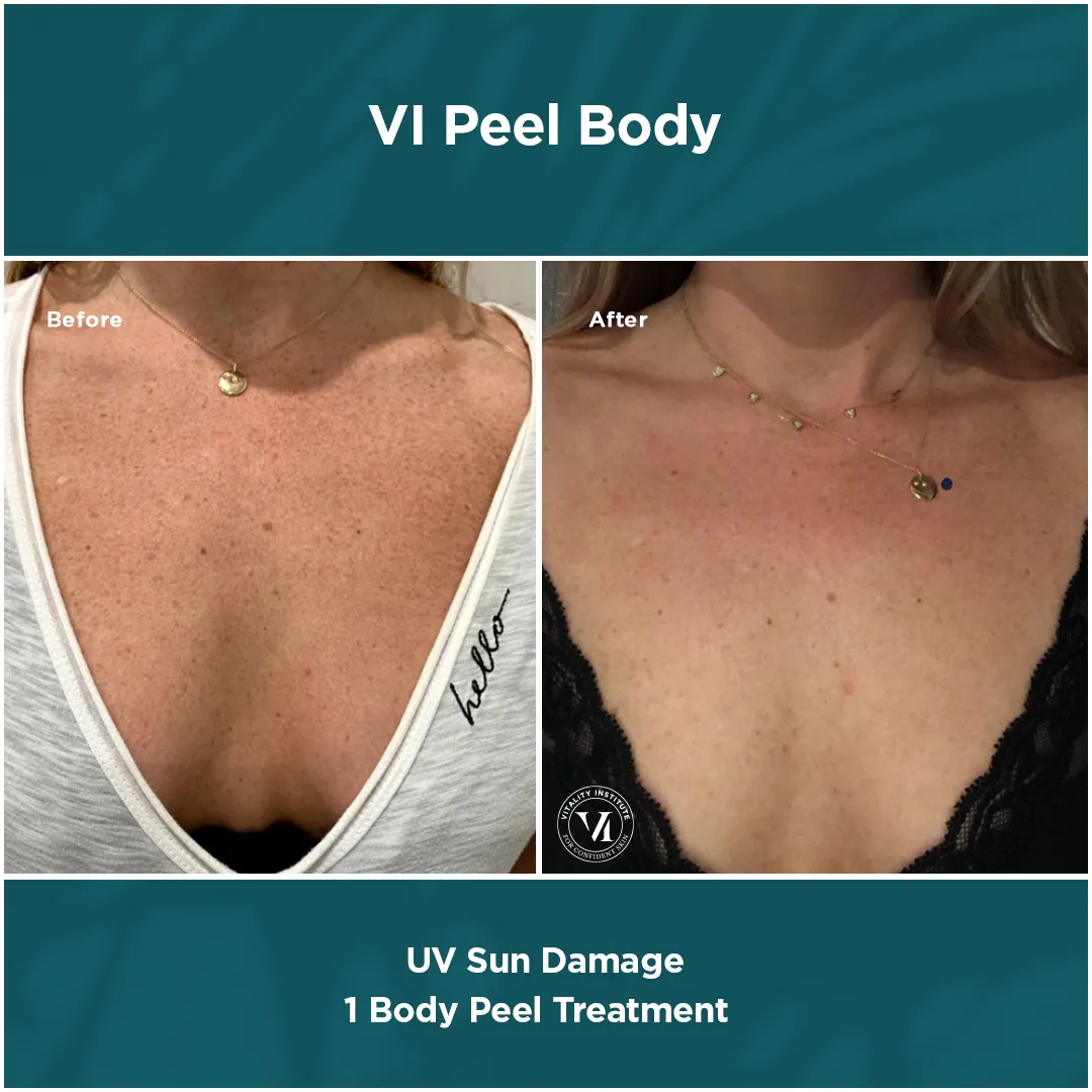 Chest and décolleté UV sun damage before and after 1 VI Peel Body treatment