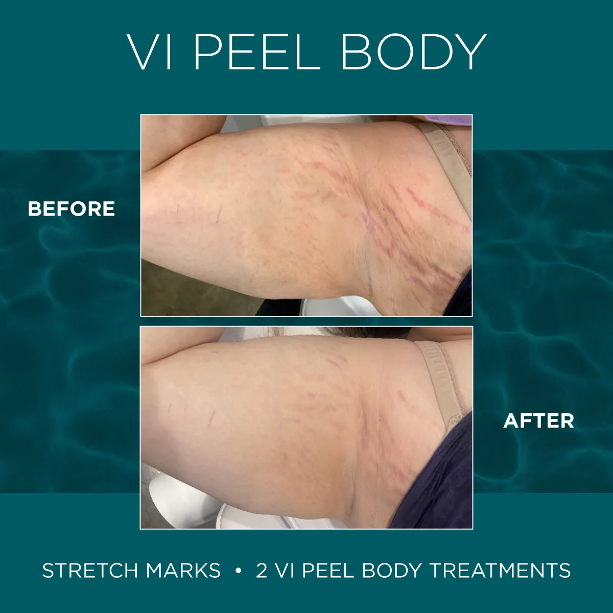 Hip and side stretch marks before and after 2 VI Peel Body treatments
