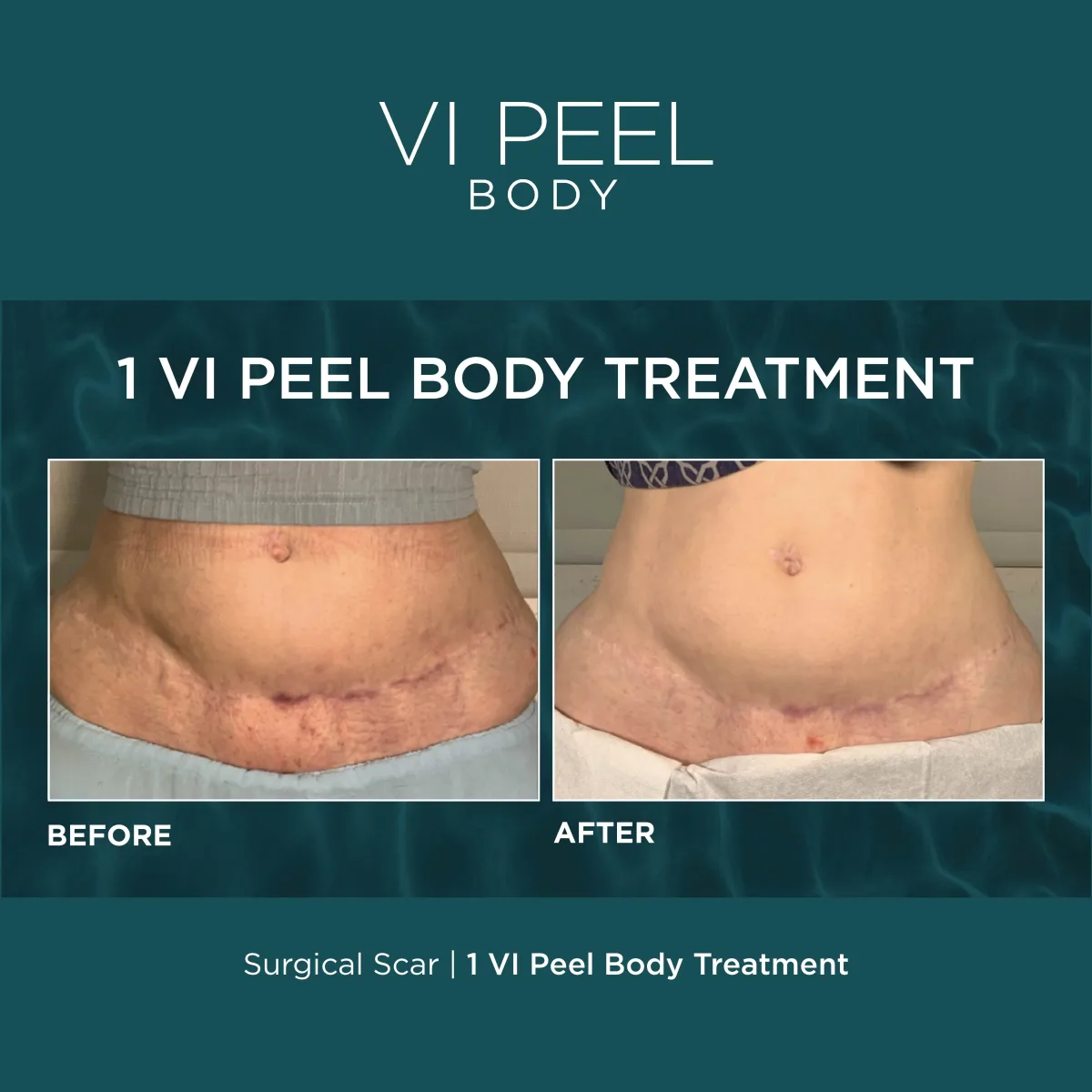 Lower abdominal surgical scar before and after 1 VI Peel Body treatment