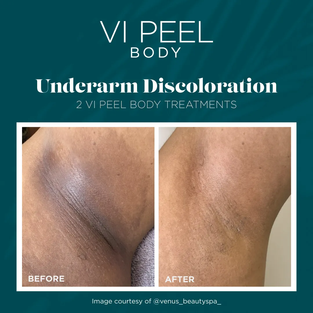 Underarm discoloration before and after 2 VI Peel Body treatments