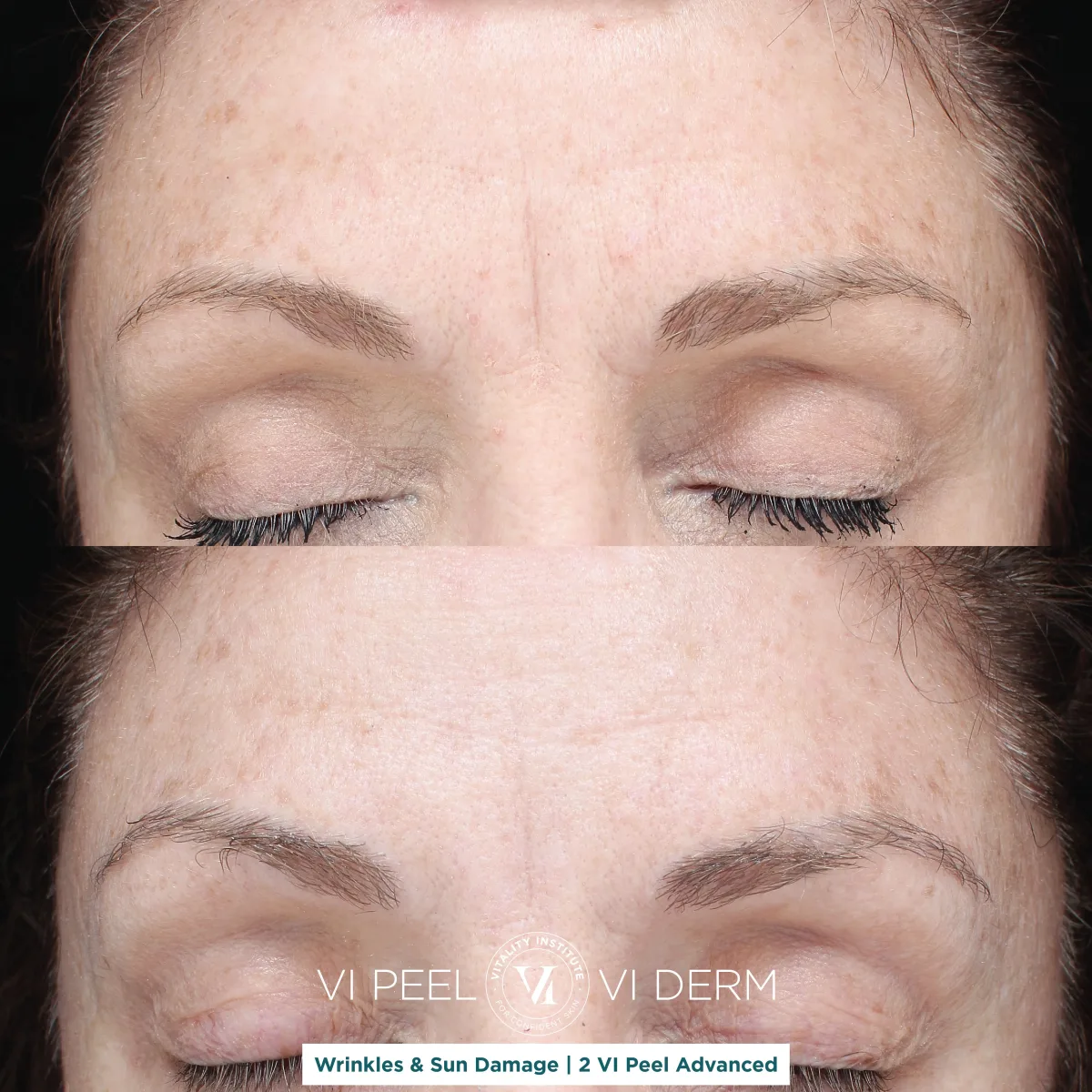 Forehead wrinkles and sun damage before and after 2 VI Peel Advanced
