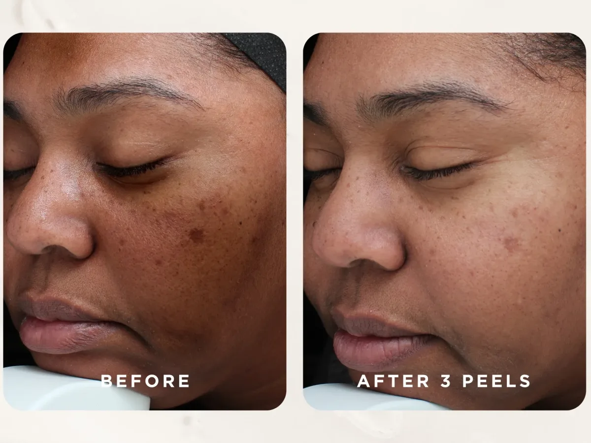 Melasma and dark spots before and after 3 VI Peel Precision + Peptides treatments